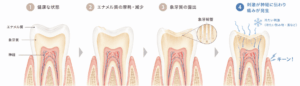 エナメル質が剥がれ、象牙質が露出するメカニズム｜あいこ歯科・矯正
