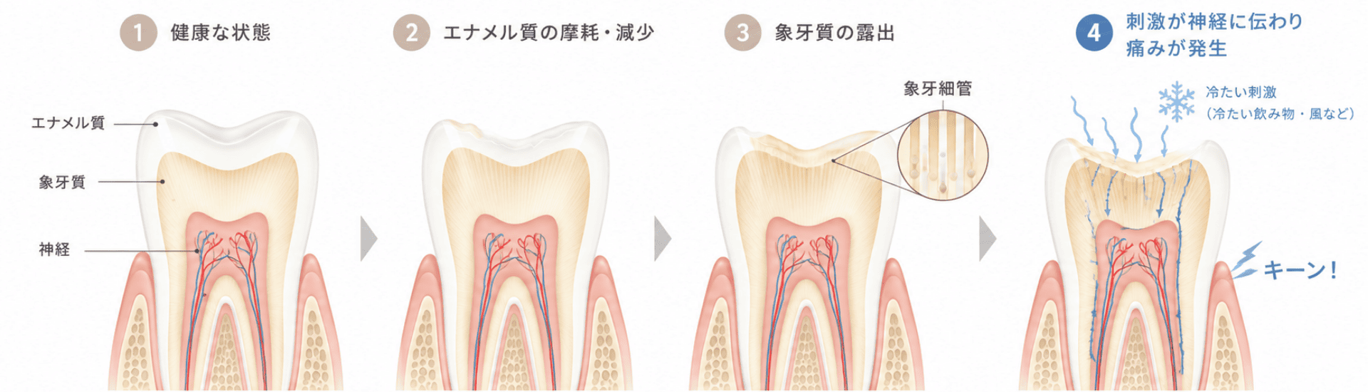 エナメル質が剥がれ、象牙質が露出するメカニズム｜あいこ歯科・矯正