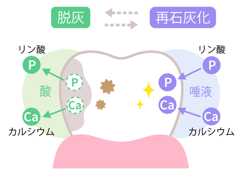 むし歯の原因と進行｜あいこ歯科・矯正
