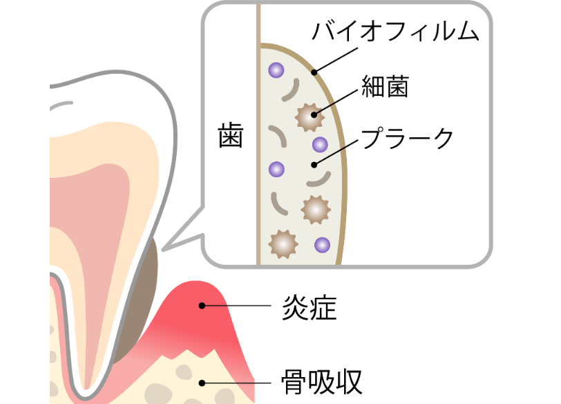 歯周病の原因と進行｜あいこ歯科・矯正